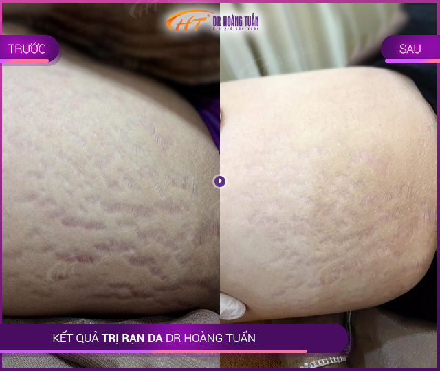 trị rạn da bằng laser trị rạn da bằng laser